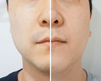 医療脱毛ビフォーアフター