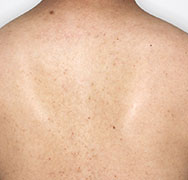 ボディ脱毛 After