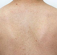 ボディ脱毛 Before