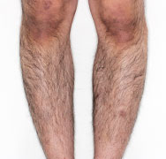 すね脱毛 Before
