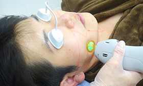 4.レーザー照射